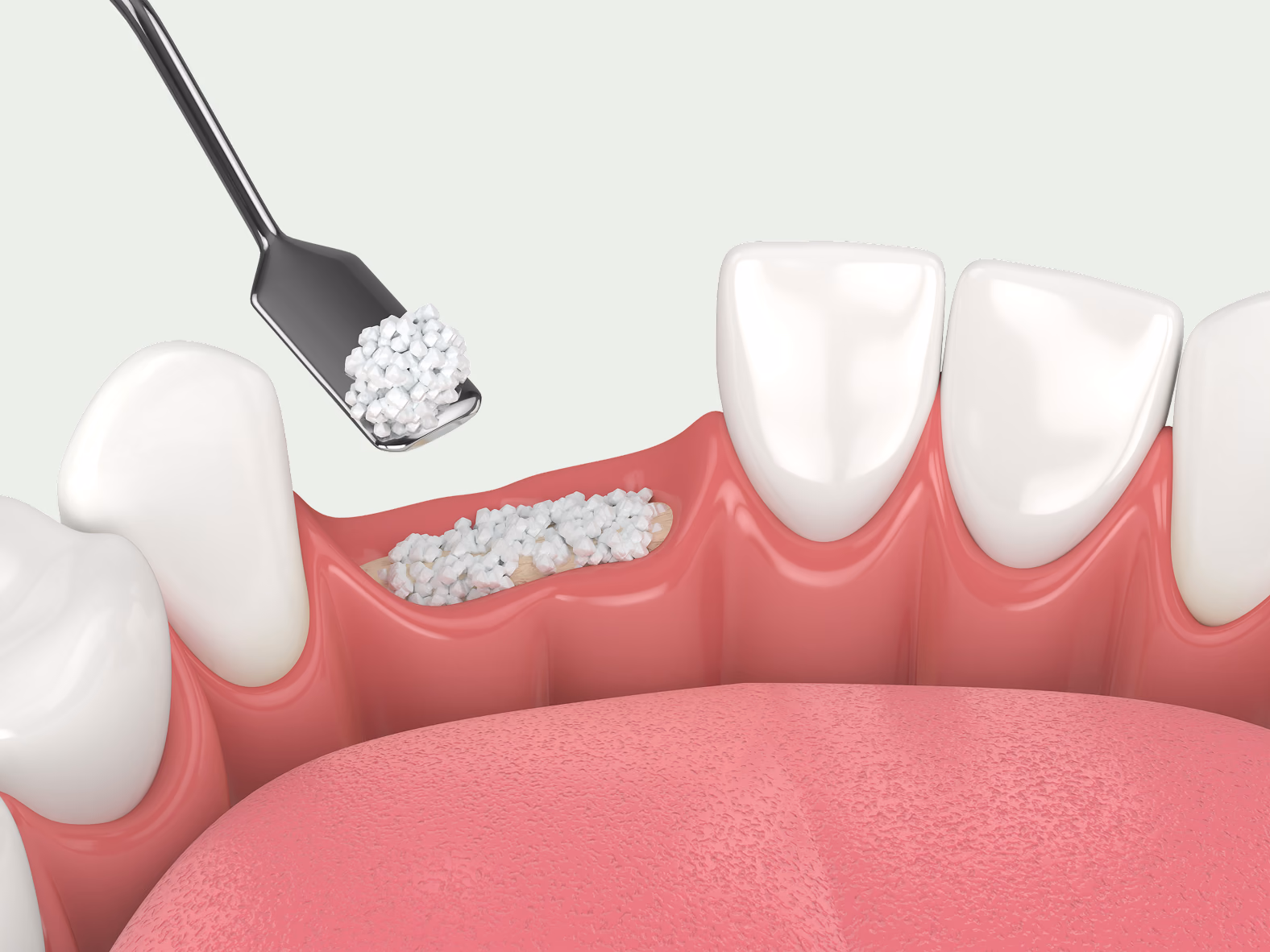 Bone Grafting — Treatment