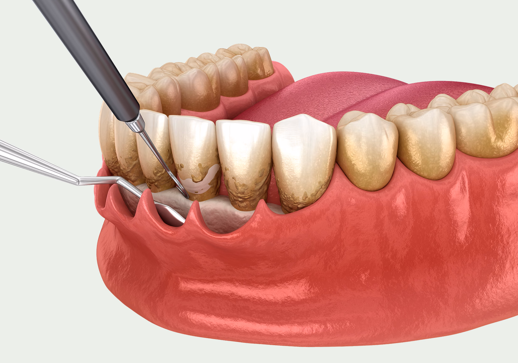 Teeth Cleaning (Deep) — Treatment