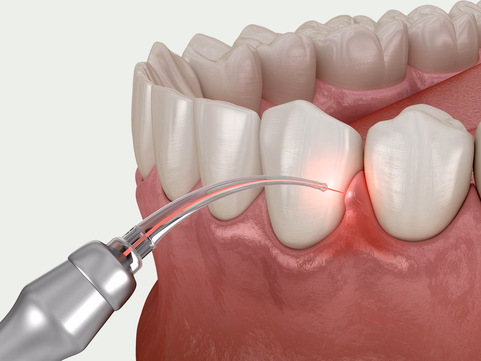 Laser Bacterial Reduction (LBR) — Treatment