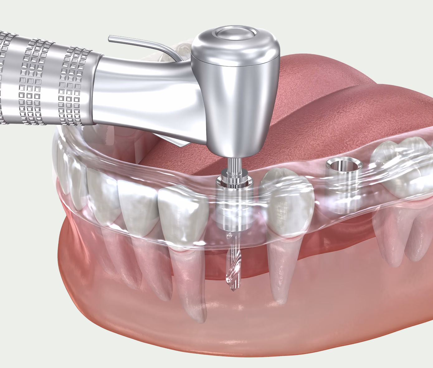 Guided dental implant treatment