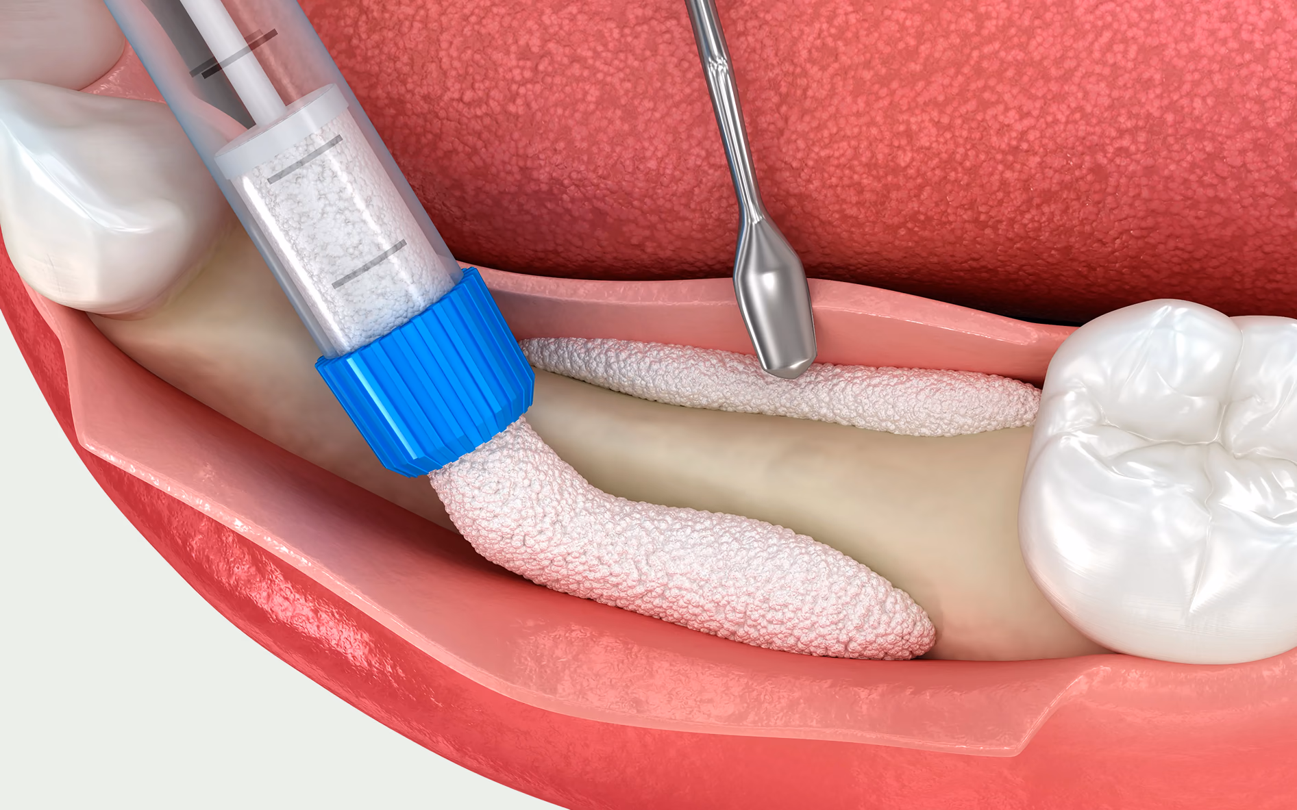 Gum Grafting — Treatment