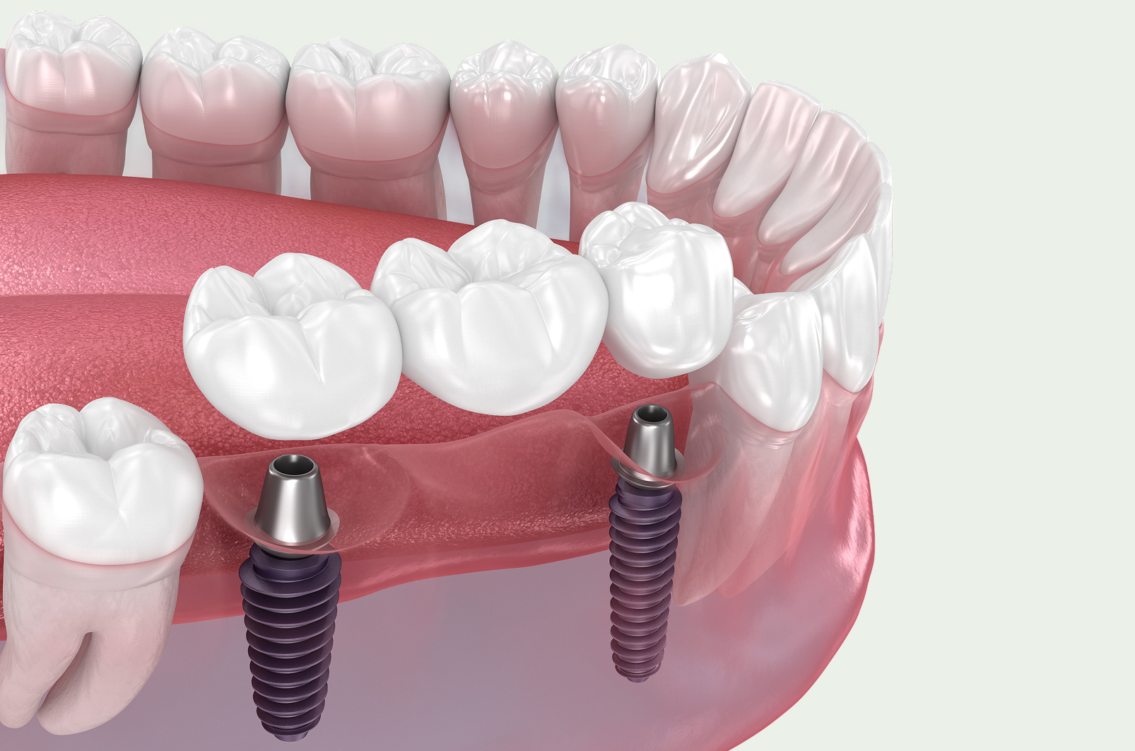 Dental Implants — Treatment
