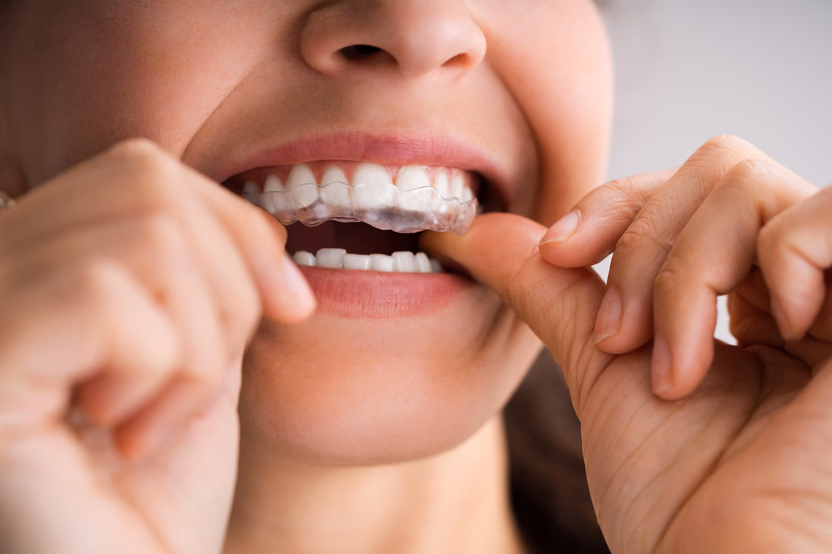 Custom Mouth Guards and Night Guards — Treatment