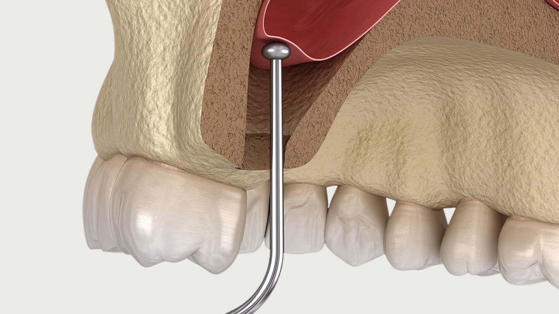 Sinus Lift Surgery — Treatment