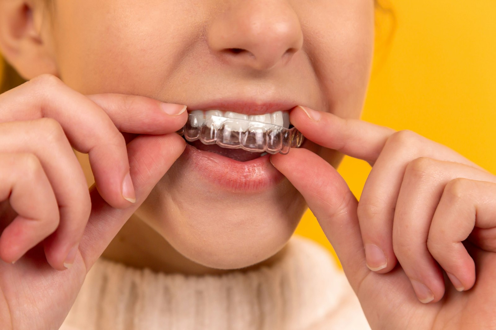 Clear Aligners (Invisalign) — Treatment