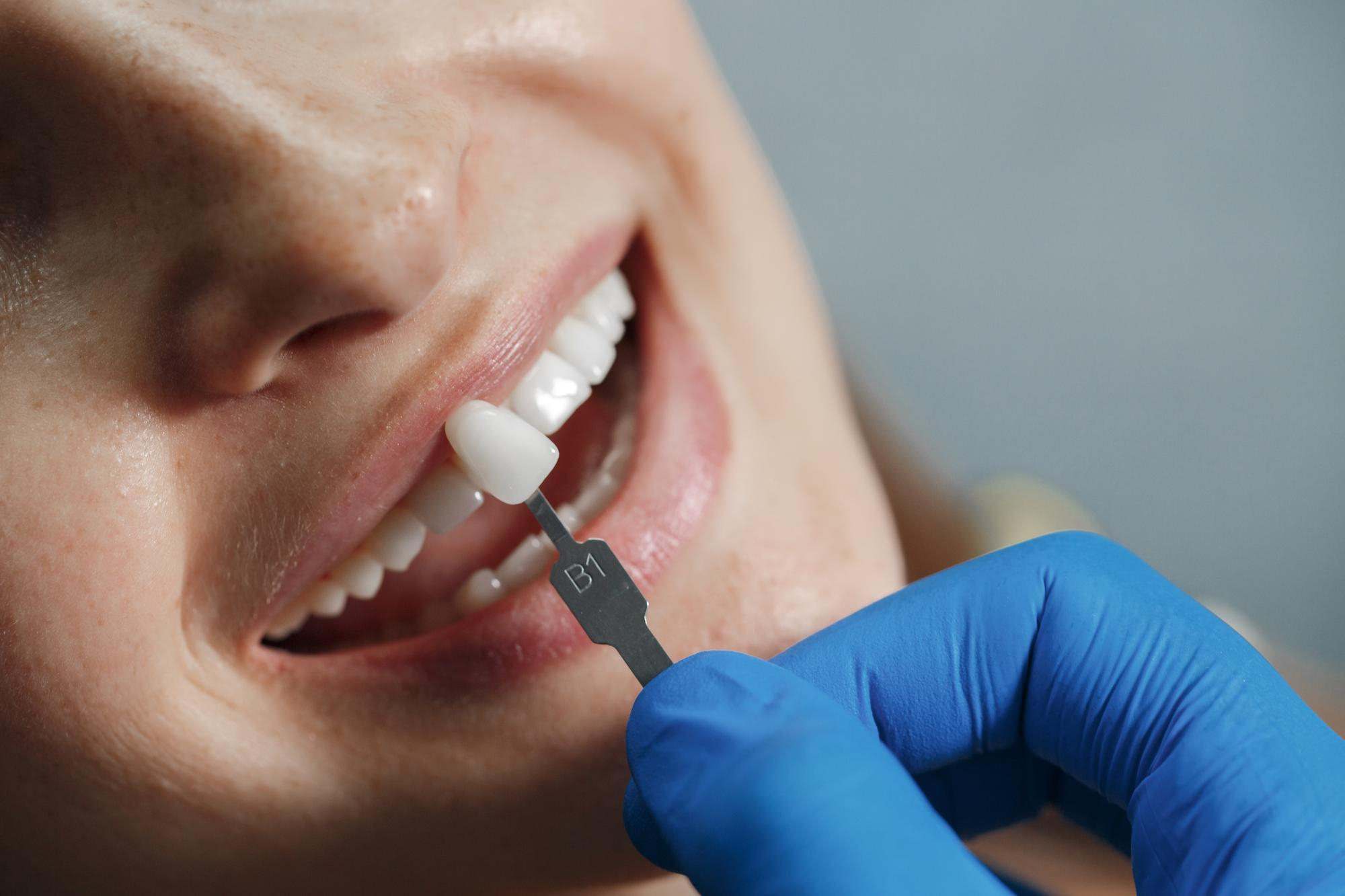 Dental Bridges — Treatment