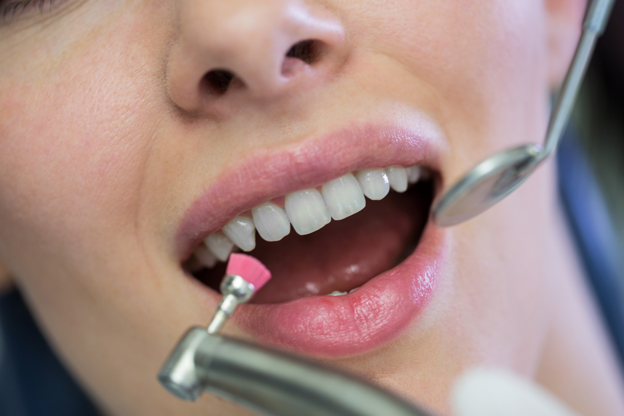 Esthetic Cosmetic Bonding — Treatment