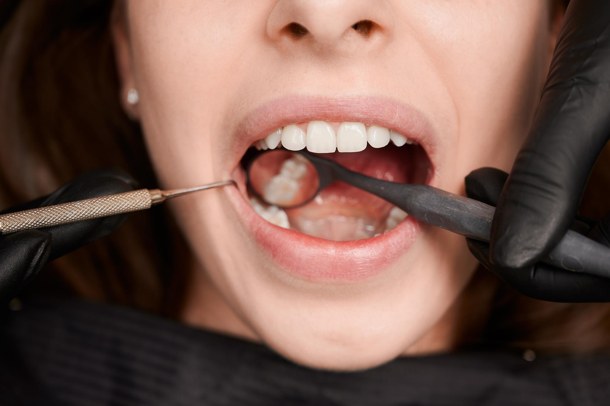 Inlays and Onlays — Treatment
