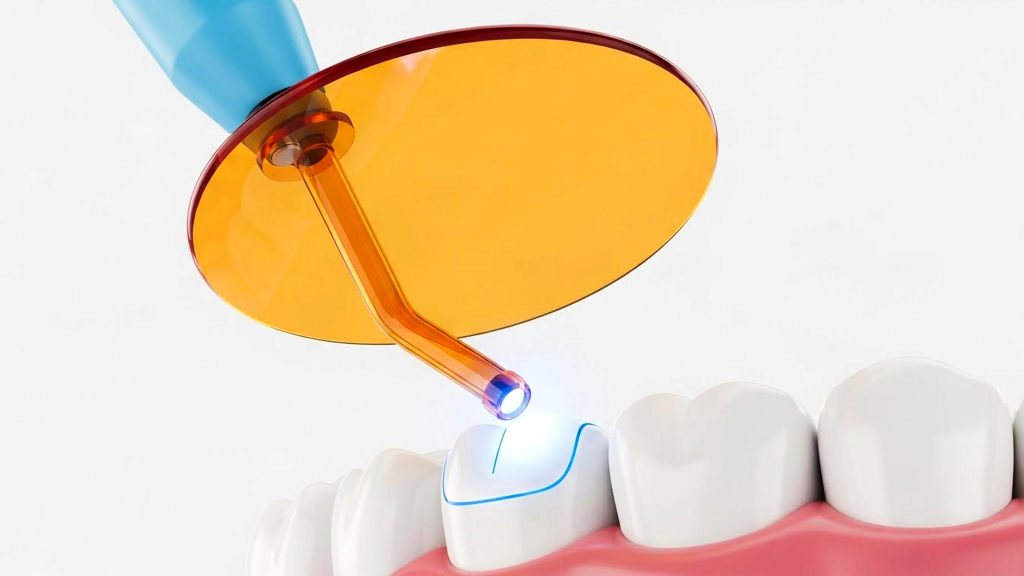 Sealants — Treatment