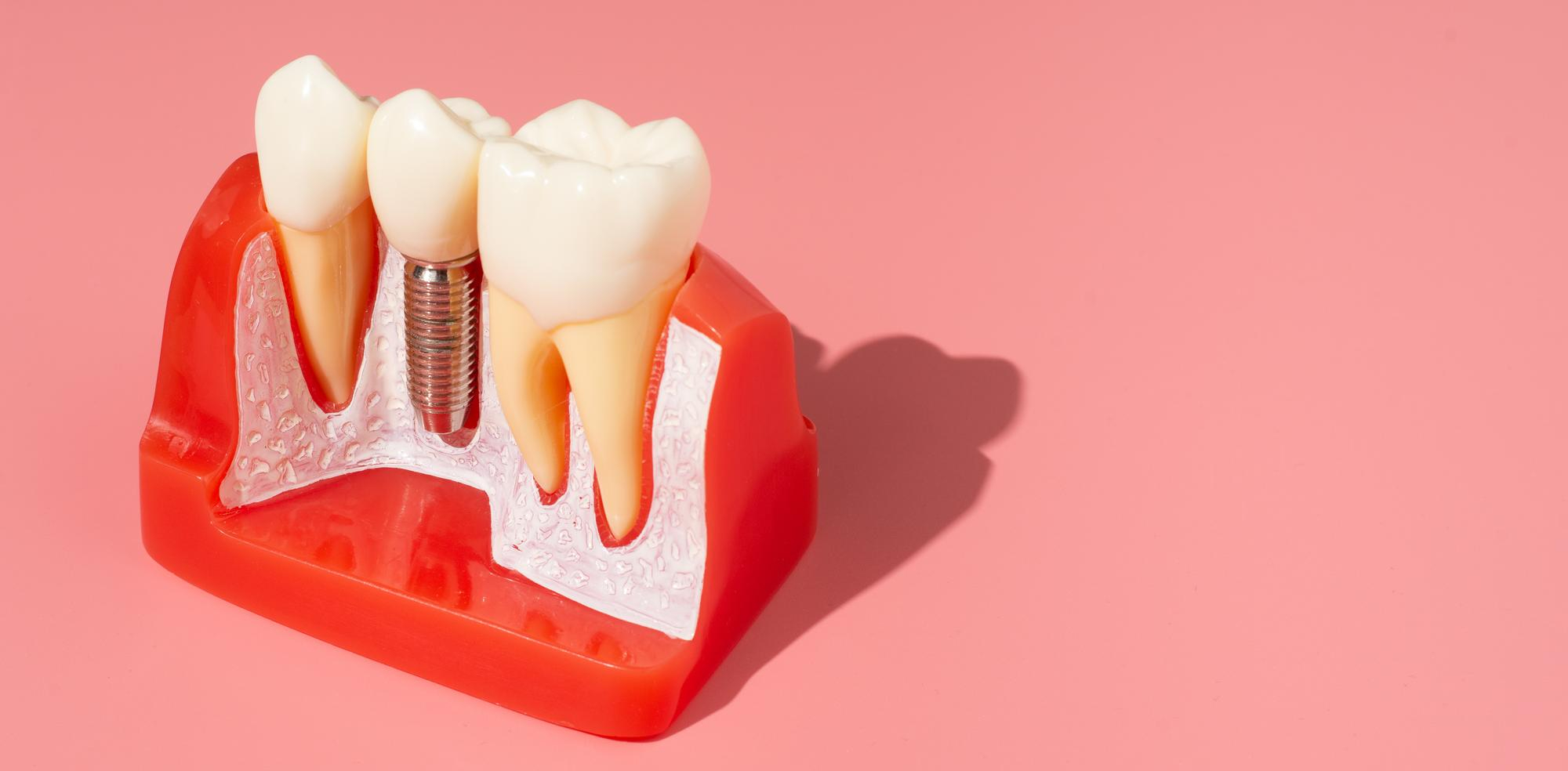 Socket Preservation — Treatment