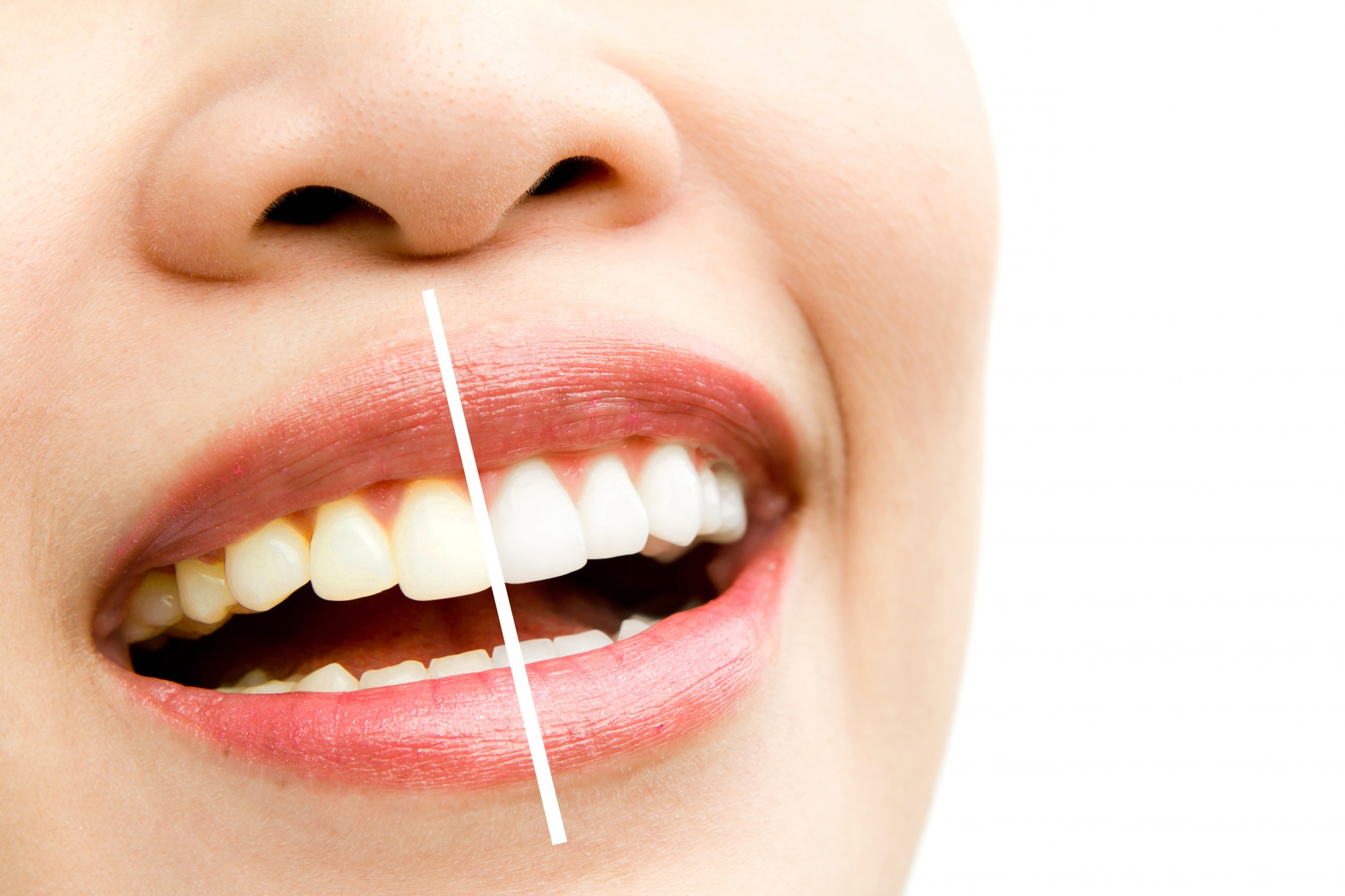 Teeth Whitening — Treatment