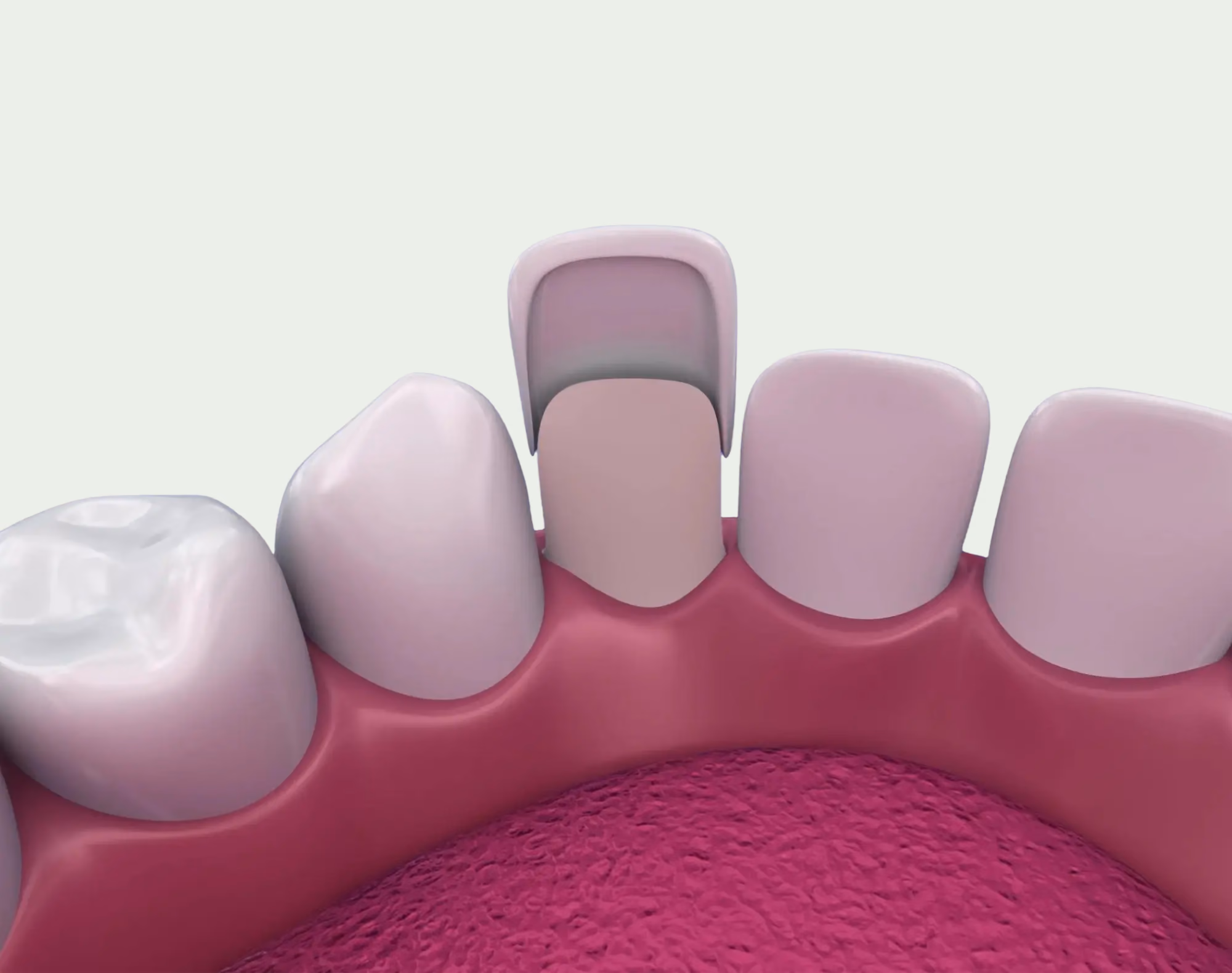 Porcelain Veneers — Treatment