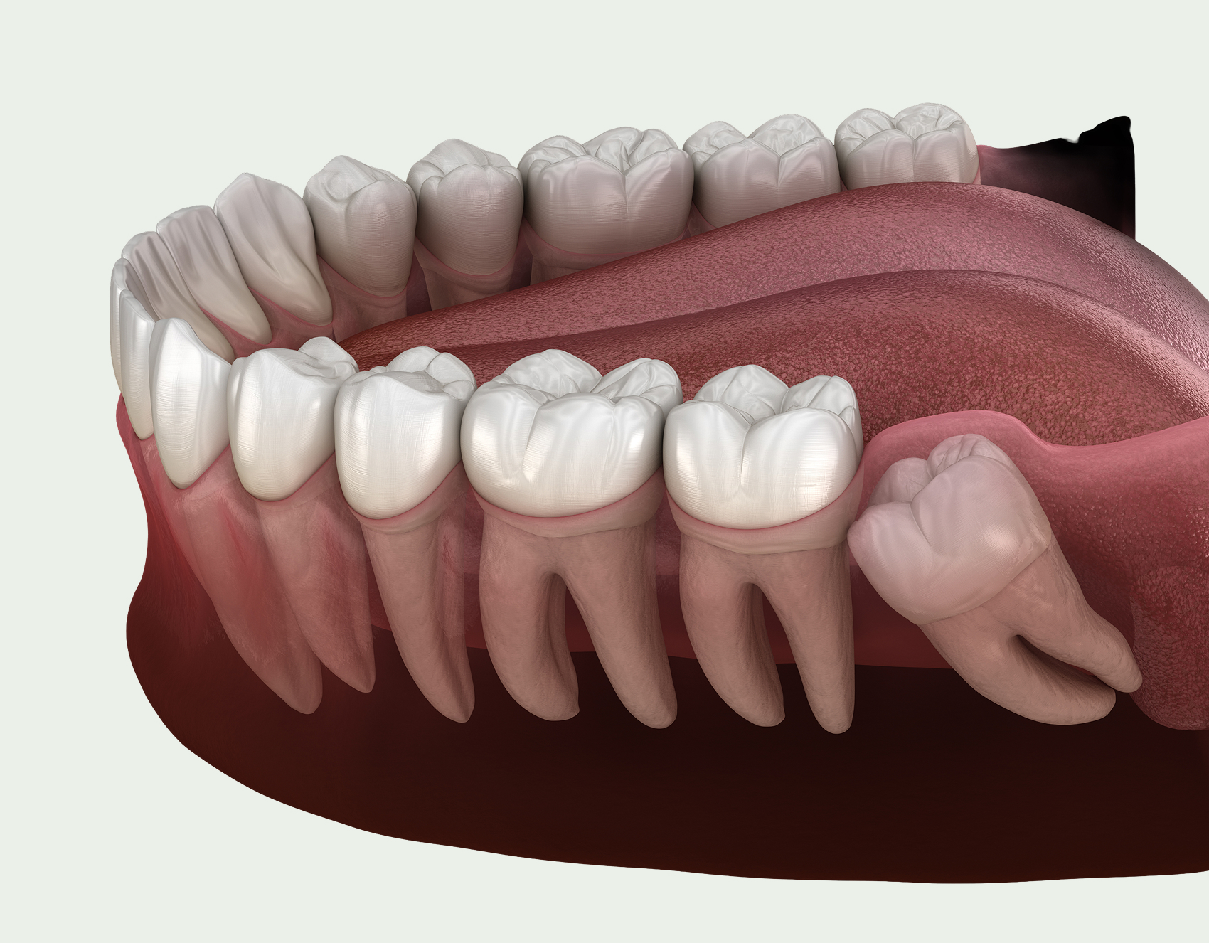 Wisdom Tooth Extractions — Treatment